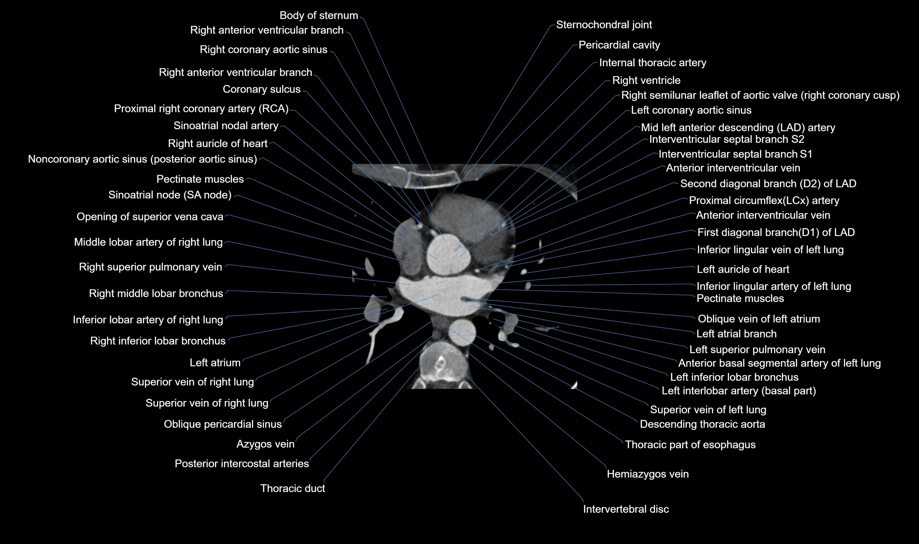 CT heart (coronary angiogram) axial view cross sectional anatomy labelled radiology image-00026.webp